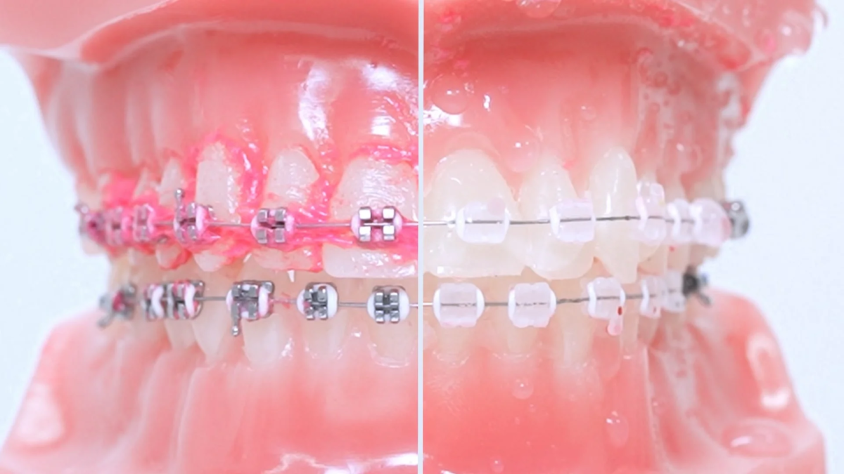 Orthodontic cleaning comparison